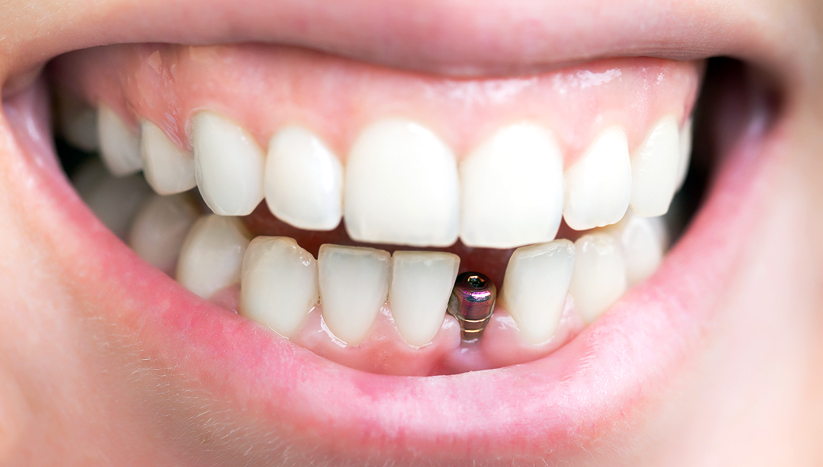 Имплантация: этапы лечения